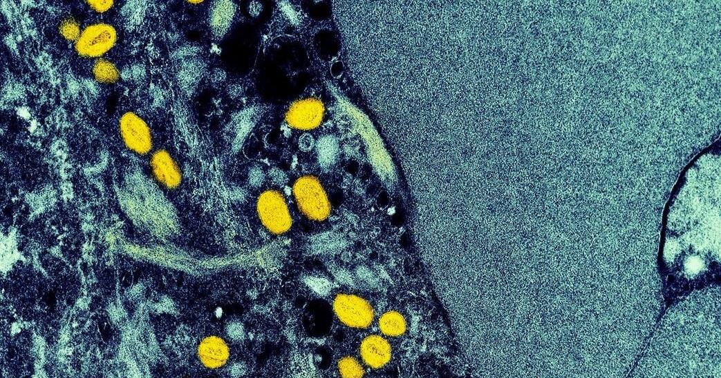 Nova Scotia is reporting its first monkeypox case in a resident