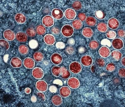 Sweden reports 1st case of more infectious form of mpox first identified in Congo