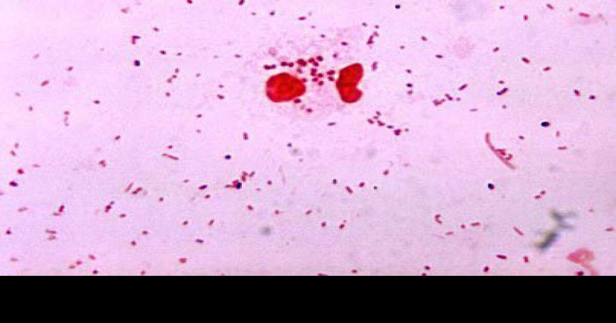first-chlamydia-herpes-rates-released-in-study