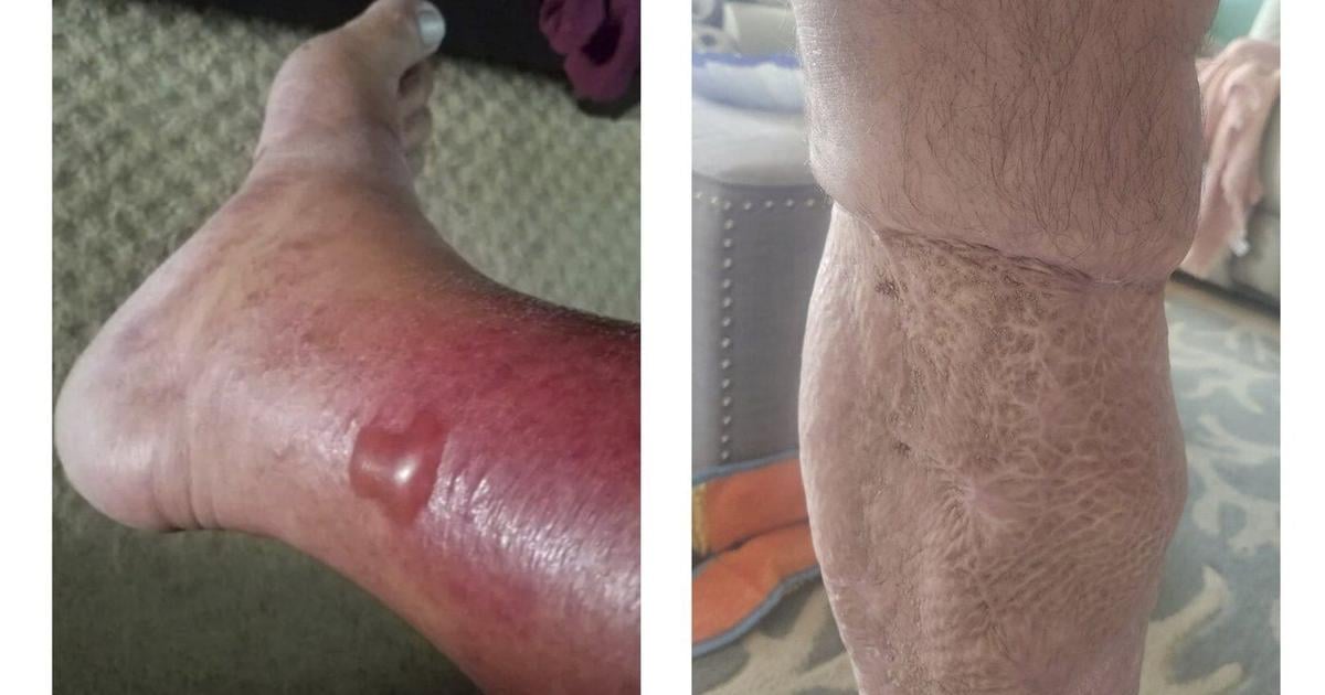 Vulnificus Protect Yourself Changing Waters While How to Protect Yourself in Changing Waters