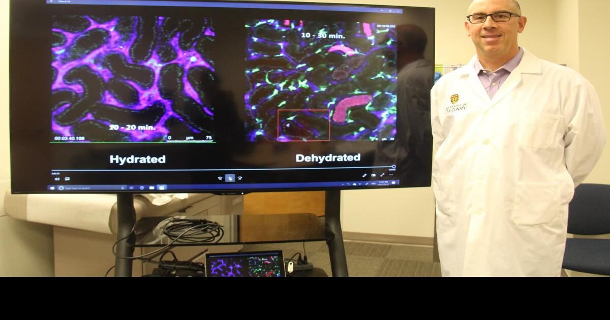 University of Calgary researchers discover ways to protect kidneys