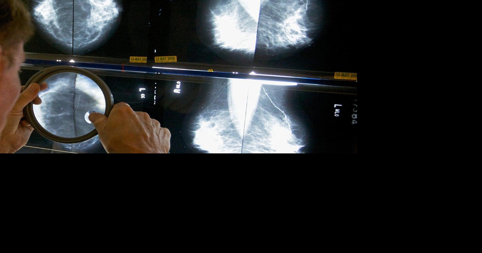 When should you get a mammogram? Conflicting advice makes it hard to know