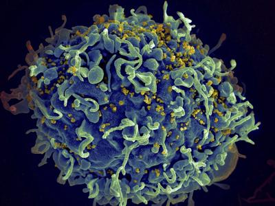UN says if US funding for HIV programs is not replaced, millions more will die by 2029