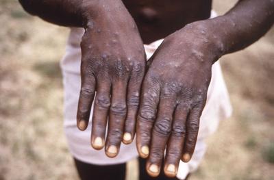 mpox monkeypox.JPG