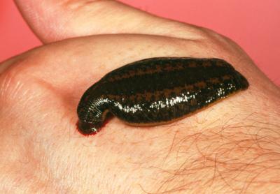 Leeches are making a comeback as medical helpers