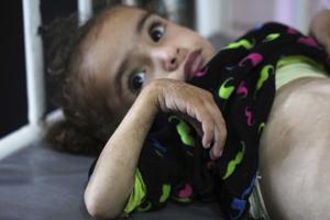 Gaza's main hospital is overwhelmed with children in pain from malnutrition