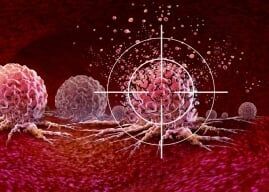 How Radiation Therapy Works for Small Cell vs. Non-Small Cell Lung Cancer