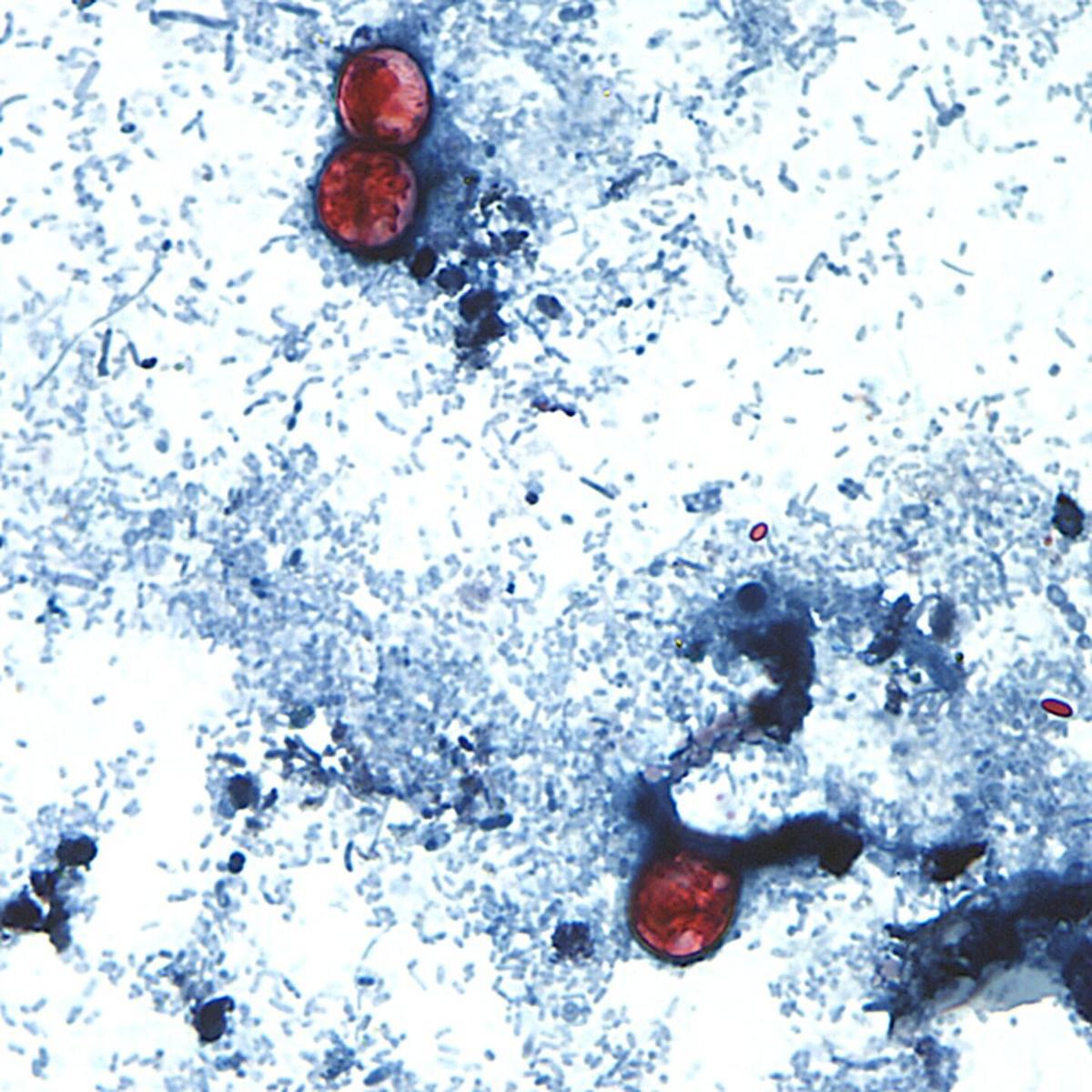 ‘It’s treatable’: MUSC expert on cyclosporiasis, cause of ‘blow-out diarrhea’