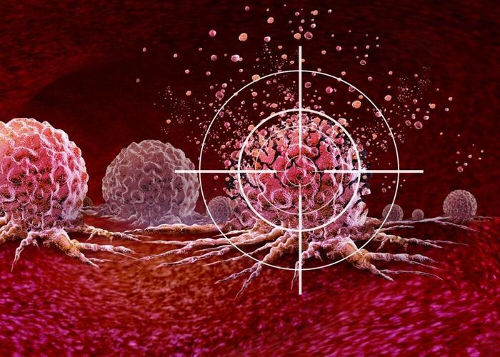 How Radiation Therapy Works for Small Cell vs. Non-Small Cell Lung Cancer