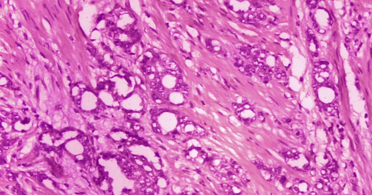 Cancer screening trip planned