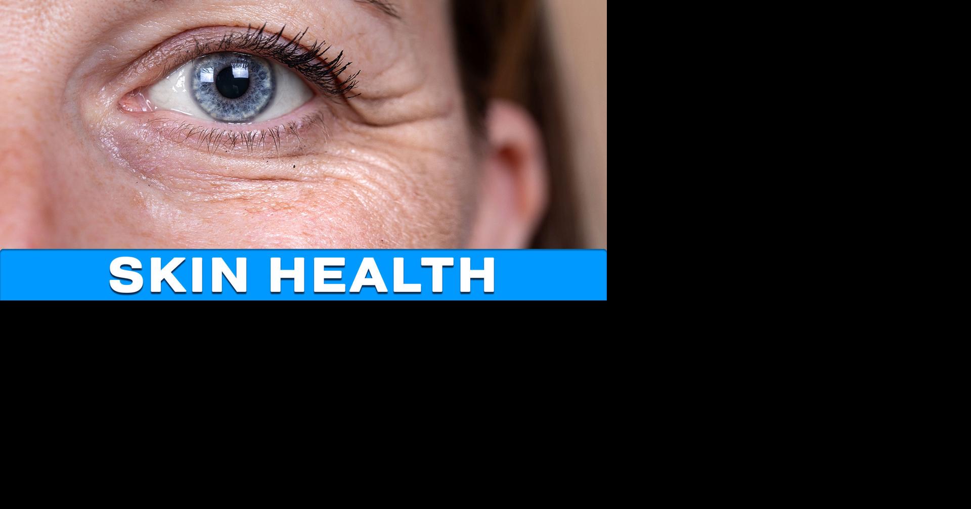 Virginia Health: Crow's Feet Wrinkles Connected to Your Skin Microbiome