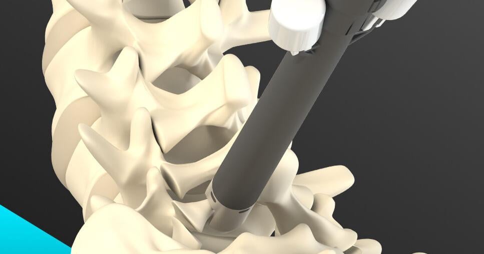 Allevion Medical™ Receives 510K Clearance for Vantage™ — A Fully Disposable Kit Featuring a Novel Approach to Spinal Decompression