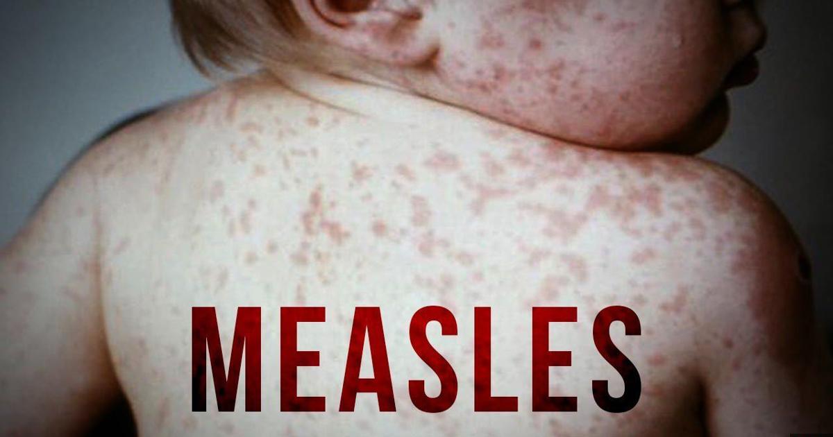 Health officials announce Kentucky measles outbreak, urge vaccination