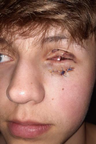 Teenager, 17, lost eye after ‘dud’ firework exploded in his face
