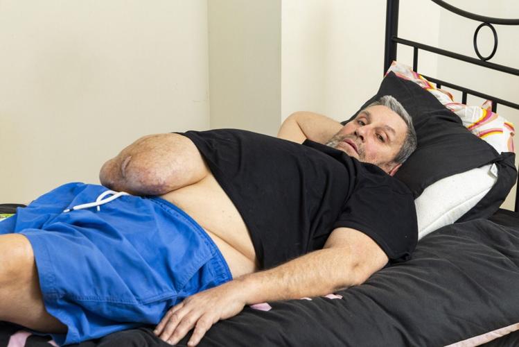 Man can’t get watermelon-sized hernia removed on NHS