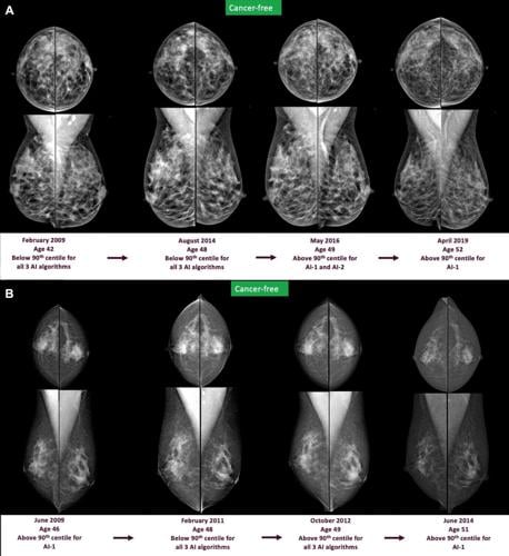 Breast cancer warning signs could be spotted up to six years in advance using AI