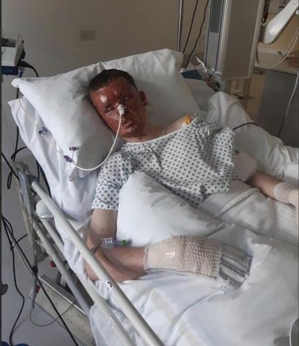 Horrific pictures show apprentice’s injuries after becoming ‘human fireball’