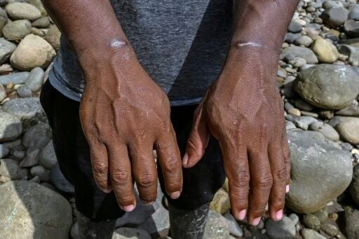 A farmer shows injuries to his wrists, which he claims were caused by the restraints used to immobilize him during a drug operation