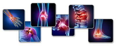 Arthritis
