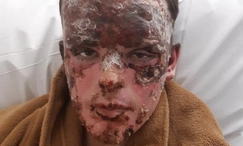 Horrific pictures show apprentice’s injuries after becoming ‘human fireball’
