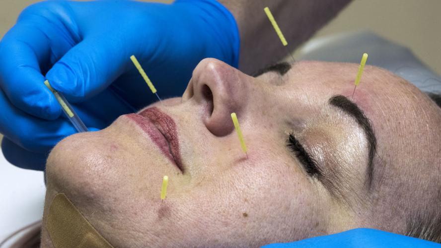What is Dry Needling?