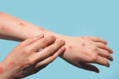 Alabama now up to 53 cases of Monkeypox