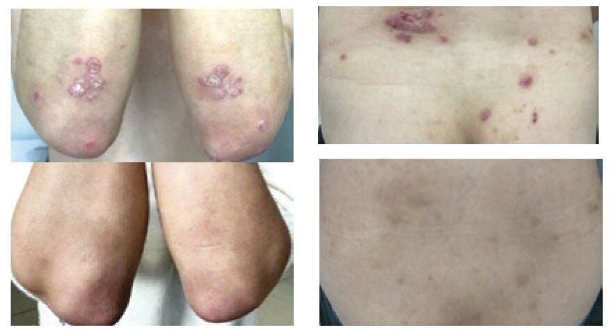 Nutritional supplements could treat skin disease psoriasis, suggests study