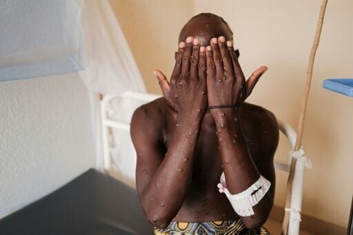 A man infected with mpox showing his hands inside a ward at the Kamenge University Hospital in Bujumbura, Burundi