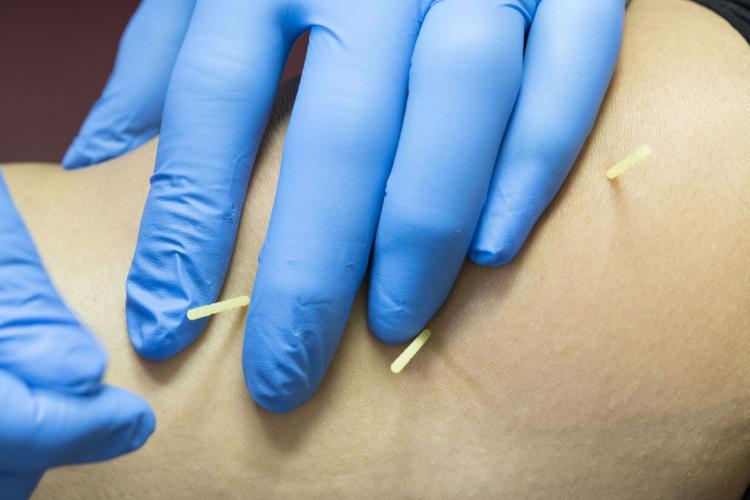 What is Dry Needling?