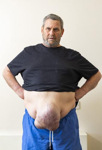 Man can’t get watermelon-sized hernia removed on NHS