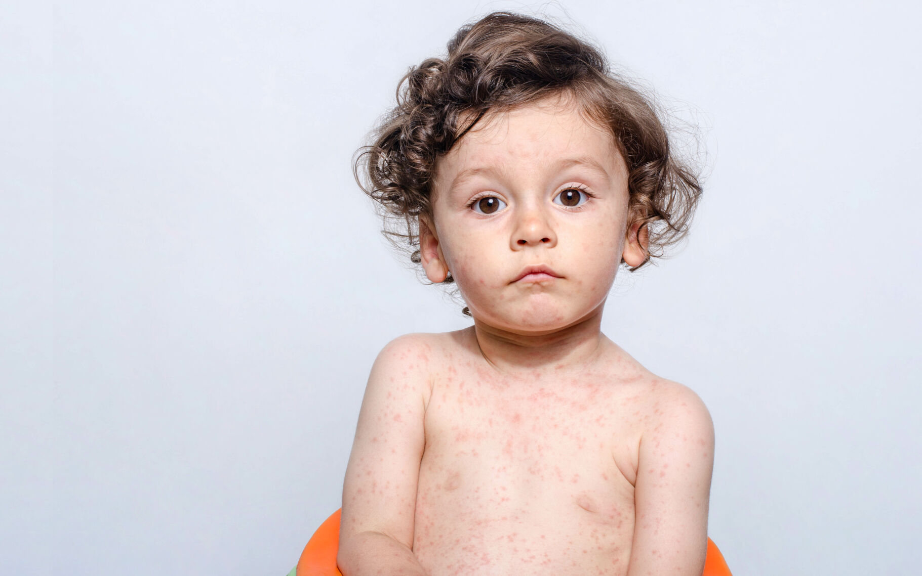 Measles Outbreak