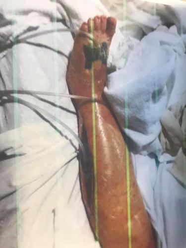 Local doctor recounts experience of patient with flesh-eating disease