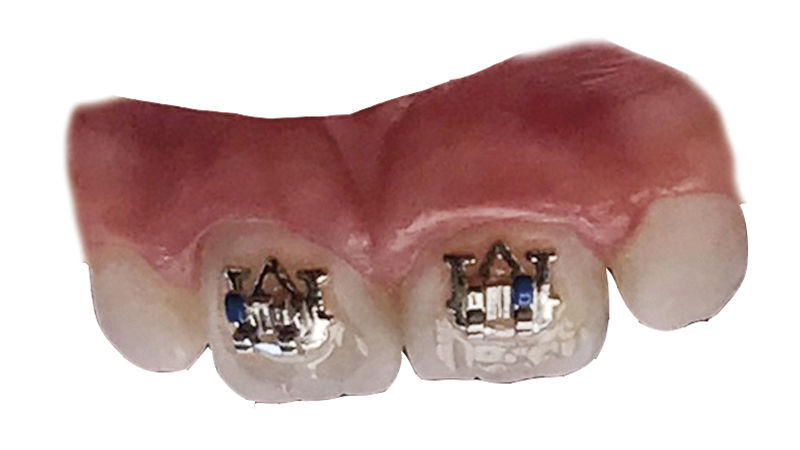 Tiger Teeth: Local orthodontist installs Auburn braces for pair of patients