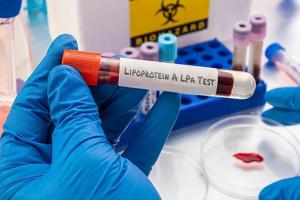 1 in 5 people may have this hidden genetic stroke risk