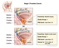 Prostate Cancer Stage I