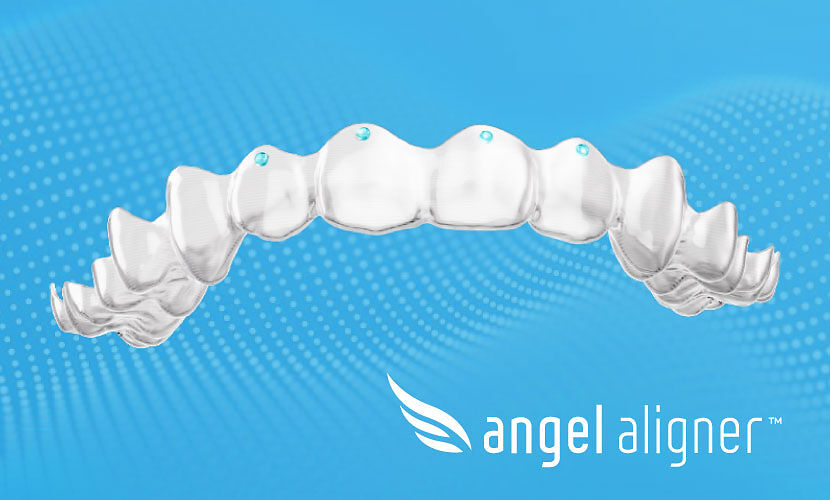 Angel Aligner Upgrades Torque Ridges to "Pressure Points" in Europe