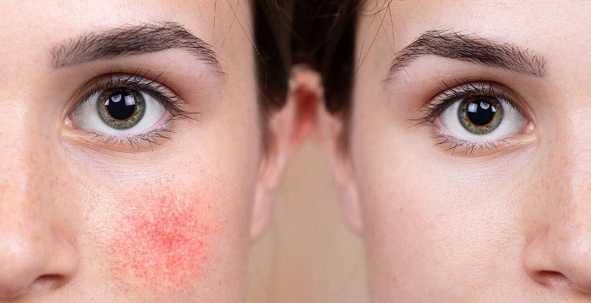 Signs and symptoms of rosacea