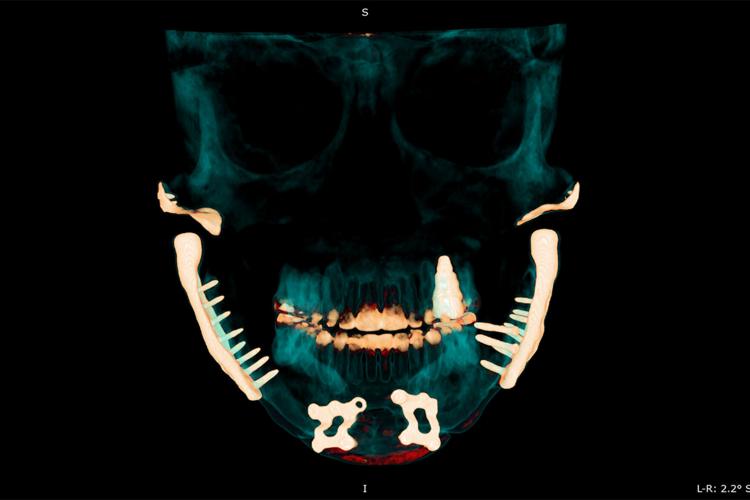 Schmidt_Jaw_Implant.jpg