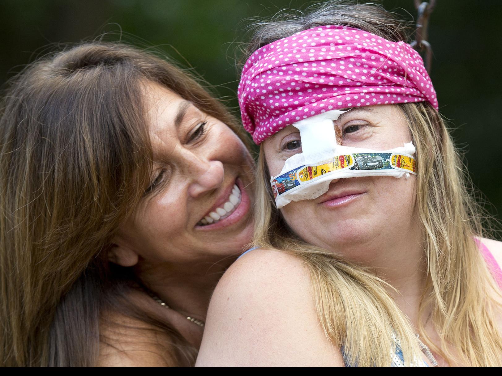 Special Olympian turns to pioneering Tucson surgeon after dog bites her face