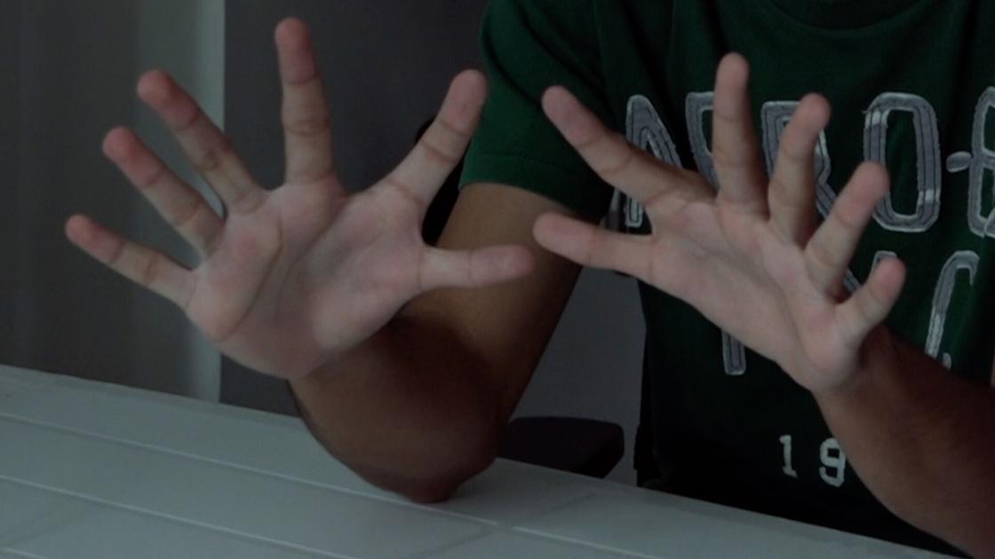 What's it like to live with 6 fingers?