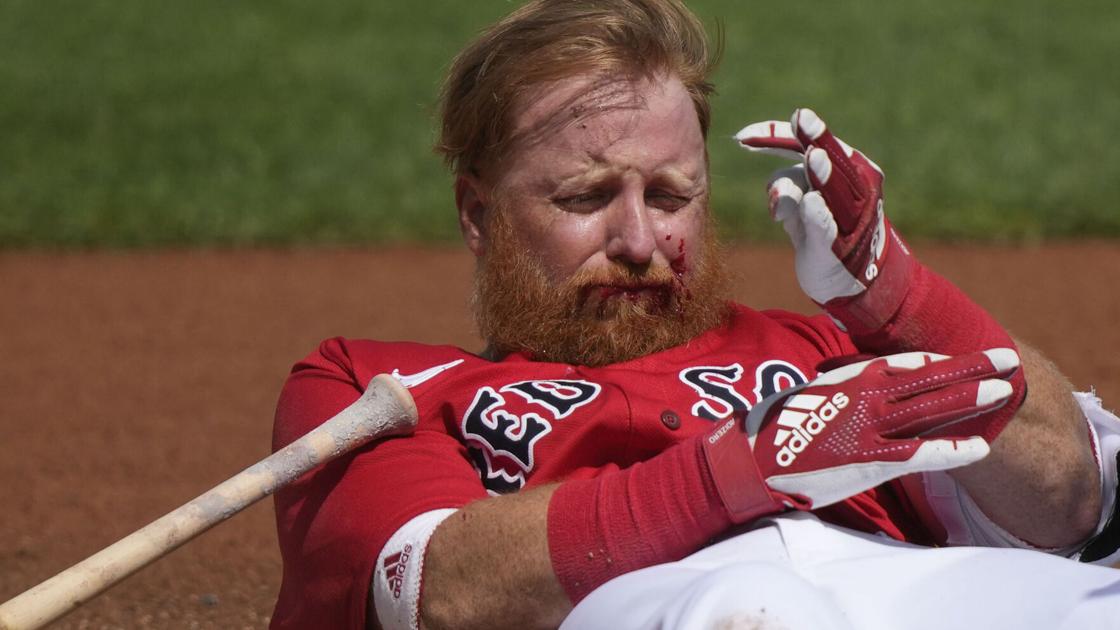 Turner gets stitches after being hit in the face during Red Sox Spring Training game