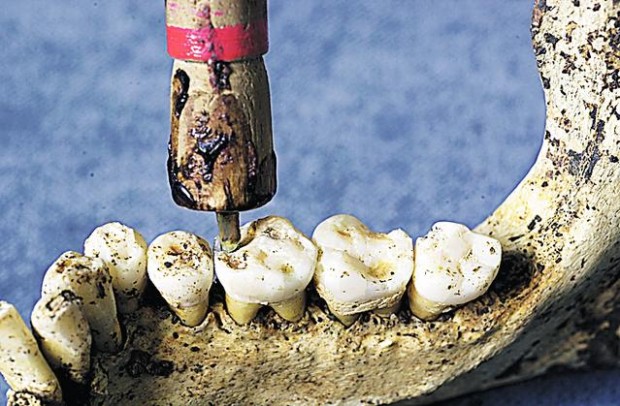 Dentists have been drilling through thousands of years  