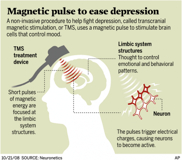'Brain zapper' is approved; blocks depression in some  