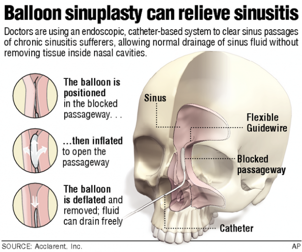 Sinus procedure takes its cue from angioplasty  