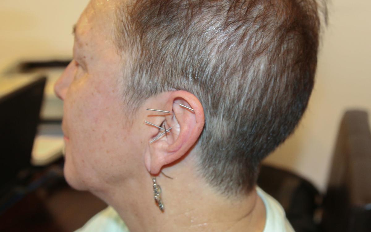 Acupuncture treatment