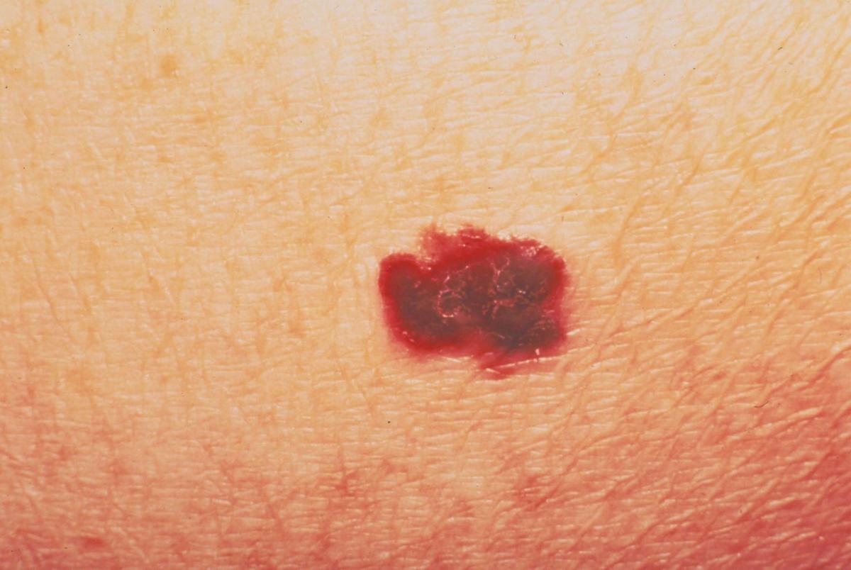 Lisa Jarvis: Cancer vaccine hunt makes progress, finally