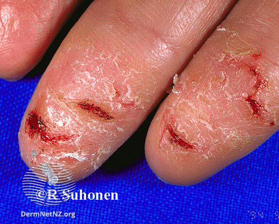 Dermatitis of the fingertips