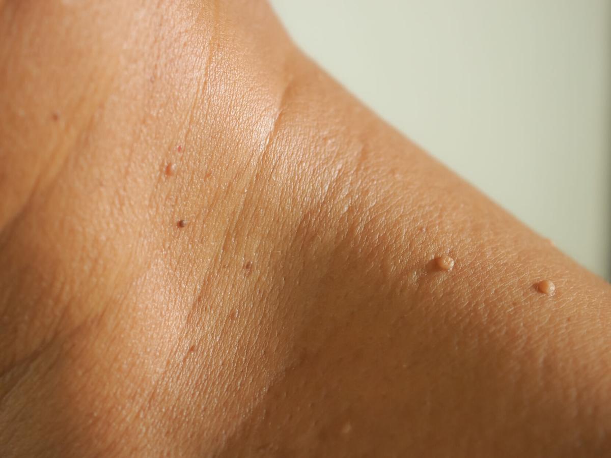 mayo-skin-tags-20210923