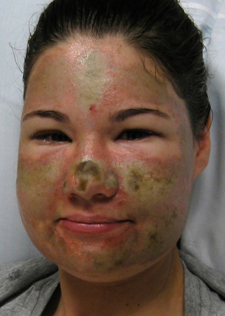 Police: Woman threw acid on her own face   