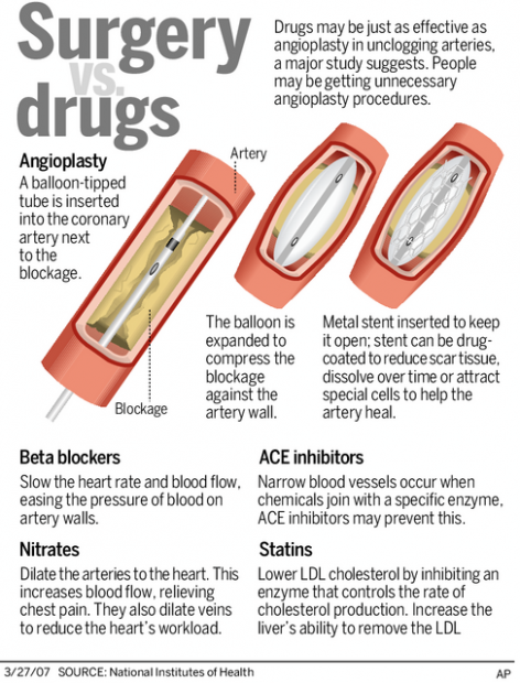 Study: Angioplasty has little value in non-emergency heart cases  